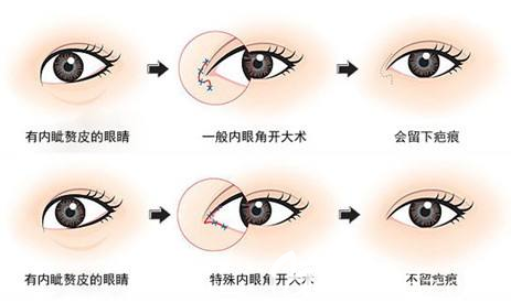 開眼角失敗修復(fù)過程示意圖