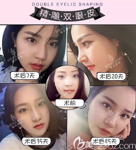 梅州曙光整形醫(yī)院雙眼皮案例