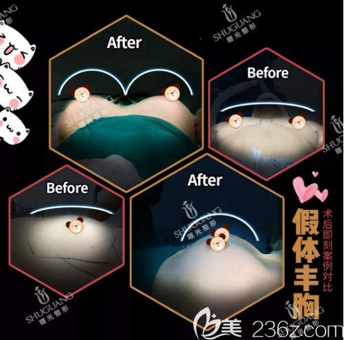 梅州曙光整形醫(yī)院假體隆胸案例