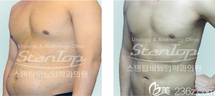 世檀塔人體雕刻案例 世檀塔人體雕刻案例