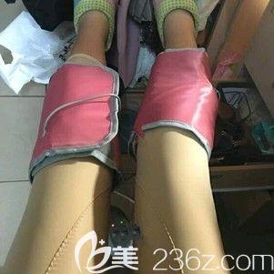 剛做完大腿環(huán)吸術(shù)后消腫恢復(fù)階段 剛做完大腿環(huán)吸術(shù)后消腫恢復(fù)階段