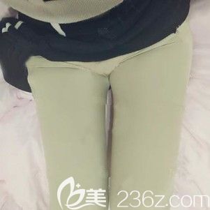 術(shù)后三天大腿吸脂的恢復(fù)情況 術(shù)后三天大腿吸脂的恢復(fù)情況