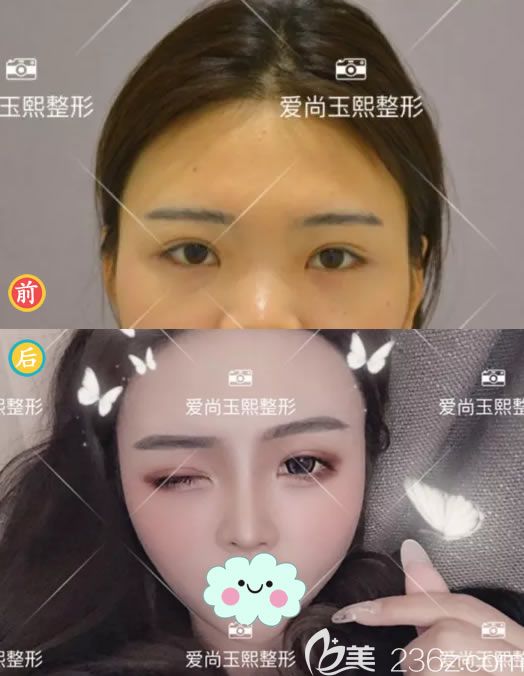 朱剛強(qiáng)隆鼻案例