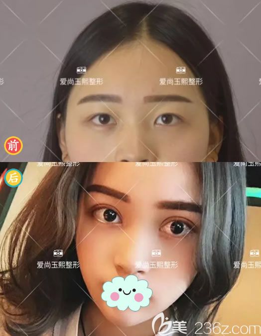 鄭靜偉院長(zhǎng)雙眼皮案例