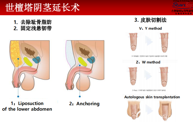 韓國世檀塔男科陰莖延長