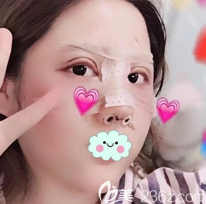 找<!--<i data=20240703-sp></i>-->朱剛強(qiáng)做鼻子4天后 找<!--<i data=20240703-sp></i>-->朱剛強(qiáng)做鼻子4天后