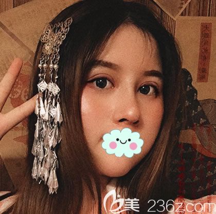 做肋軟骨隆鼻拆線3天效果圖片 做肋軟骨隆鼻拆線3天效果圖片