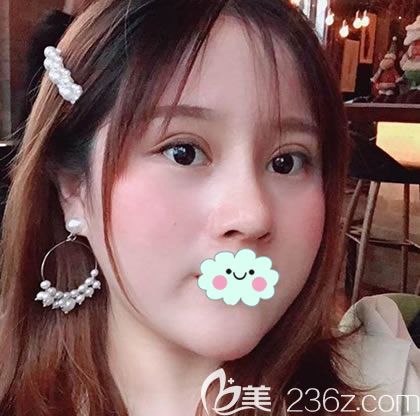 從事前臺工作的妹子來強(qiáng)做了肋軟骨鼻綜合隆鼻手術(shù)