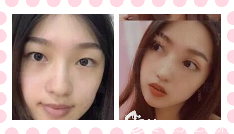 重慶時光整形全切雙眼皮案例