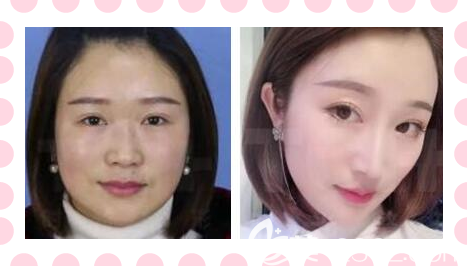 重慶時光隆鼻好不好？