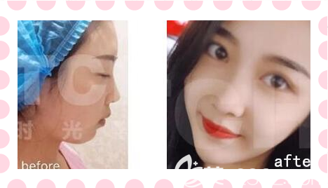 重慶時光醫(yī)院能墊下巴嗎？