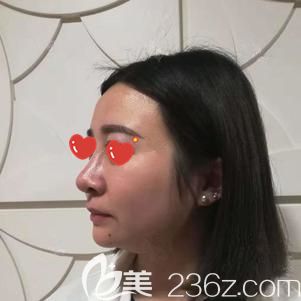 到武漢美基元做鼻部修復(fù)前自己歪斜的鼻子 到武漢美基元做鼻部修復(fù)前自己歪斜的鼻子