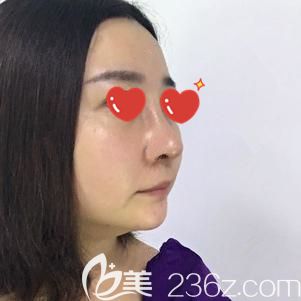 汪福強(qiáng)院長(zhǎng)幫我做鼻部修復(fù)術(shù)后7天拆線(xiàn) 汪福強(qiáng)院長(zhǎng)幫我做鼻部修復(fù)術(shù)后7天拆線(xiàn)