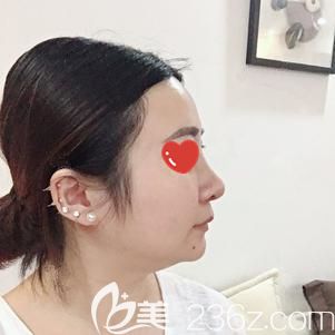 做鼻部修復(fù)術(shù)后29天鼻子疤痕消失 做鼻部修復(fù)術(shù)后29天鼻子疤痕消失