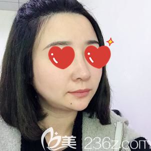 貪便宜做假體隆鼻歪斜后糾結(jié)許久到武漢美基元做了鼻部修復(fù)，才明白想要好效果就要找正規(guī)機(jī)構(gòu)