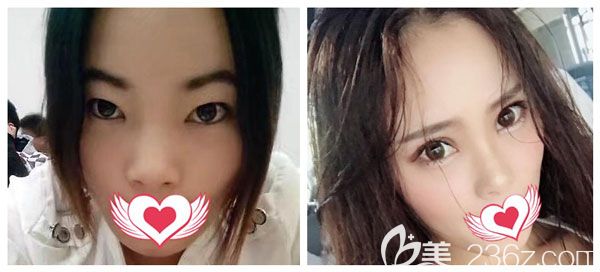 昆明夢想全切雙眼皮+開眼角案例效果 昆明夢想全切雙眼皮+開眼角案例效果