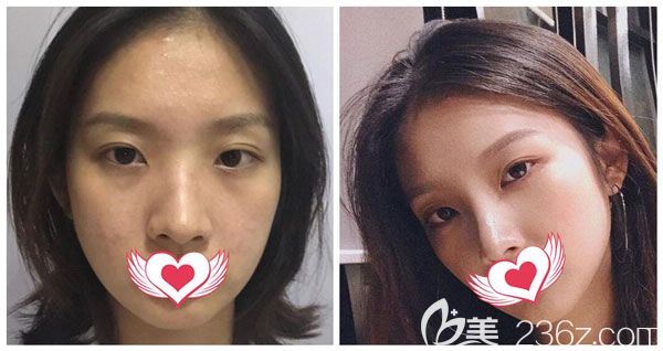 昆明夢想鼻綜合+肋軟骨隆鼻案例效果對比圖 昆明夢想鼻綜合+肋軟骨隆鼻案例效果對比圖