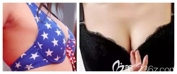 昆明夢想整形自體脂肪豐胸案例 昆明夢想整形自體脂肪豐胸案例