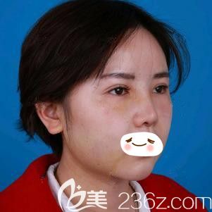 在石家莊天宏做面部吸脂術(shù)后面部微腫 在石家莊天宏做面部吸脂術(shù)后面部微腫