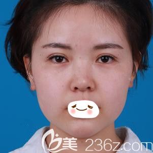 在石家莊天宏做面部吸脂術(shù)前是嬰兒肥臉 在石家莊天宏做面部吸脂術(shù)前是嬰兒肥臉