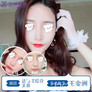 王金洲醫(yī)生做達(dá)拉斯綜合隆鼻術(shù)后100天恢復(fù)自然