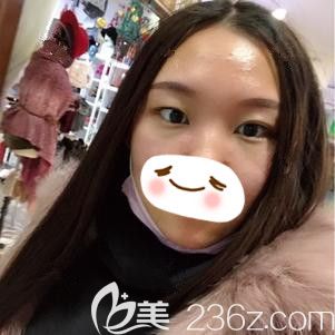 在石家莊天宏做內(nèi)切祛眼袋術(shù)后一周完全消腫