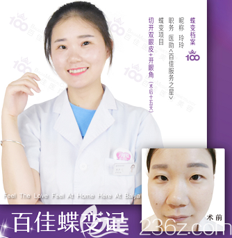 丁福亮醫(yī)生全切雙眼皮案例二