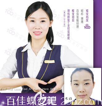 丁福亮醫(yī)生全切雙眼皮案例三