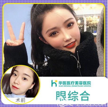 呼和浩特華醫(yī)整形王春燕全切雙眼皮+開眼角效果案例分