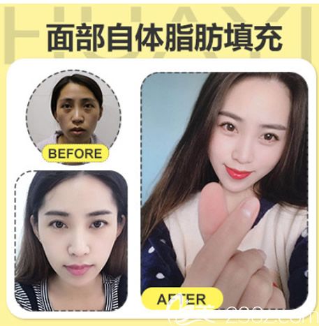 呼市華醫(yī)整形宋耀宗面部脂肪填充效果怎么樣