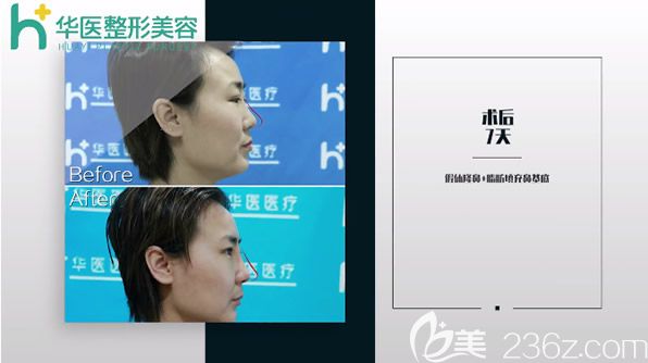 華醫(yī)宋耀宗硅膠假體隆鼻+自體軟骨隆鼻第天效果 華醫(yī)宋耀宗硅膠假體隆鼻+自體軟骨隆鼻第天效果