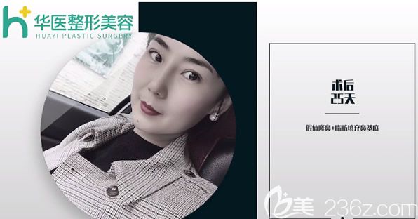 呼和浩特華醫(yī)宋耀宗鼻綜合隆鼻25天恢復(fù)圖片 呼和浩特華醫(yī)宋耀宗鼻綜合隆鼻25天恢復(fù)圖片