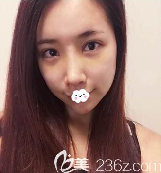 韓國樂希lush整形外科韓式眼綜合+鼻綜合隆鼻術(shù)后1周恢復(fù)效果圖