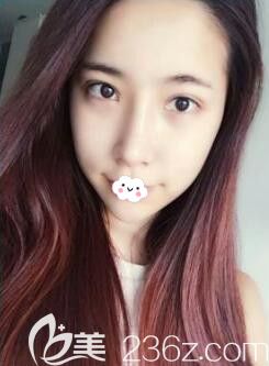 鼻綜合隆鼻一個(gè)月恢復(fù)不錯(cuò)將韓國樂希lush整形外科韓式眼綜合照片+做鼻子案例公開