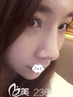 韓國樂希雙眼皮開眼角+假體隆鼻+耳軟骨墊鼻尖術(shù)后恢復(fù)效果圖