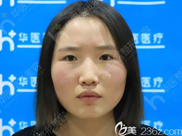 呼和浩特華醫(yī)整形美容門診部劉露院長眼綜合整形前 呼和浩特華醫(yī)整形美容門診部劉露院長眼綜合整形前