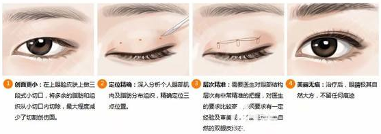 韓國(guó)普拉美斯割雙眼皮過(guò)程