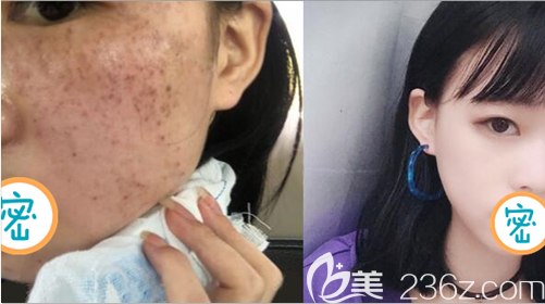 內(nèi)江達(dá)芬奇激光祛斑術(shù)前術(shù)后對(duì)比效果圖 內(nèi)江達(dá)芬奇激光祛斑術(shù)前術(shù)后對(duì)比效果圖