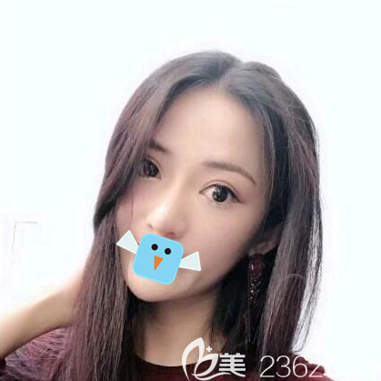 內(nèi)江達(dá)芬奇陳科激光去眼袋治療速度好快，半個多小時就結(jié)束了，完全不影響我正常工作