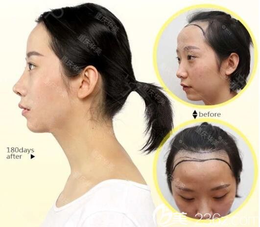 重慶華美整形發(fā)際線種植案例