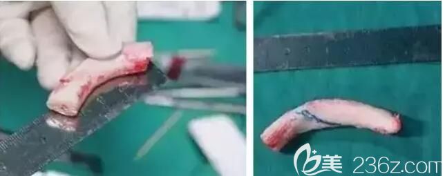 鼻修復過程<!--<i data=20240703-sp></i>-->京華韓奇致醫(yī)生取出肋軟骨雕刻 鼻修復過程<!--<i data=20240703-sp></i>-->京華韓奇致醫(yī)生取出肋軟骨雕刻