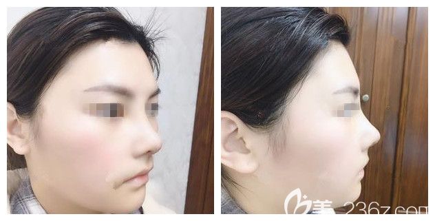 全肋軟骨鼻綜合術后五天恢復情況 全肋軟骨鼻綜合術后五天恢復情況