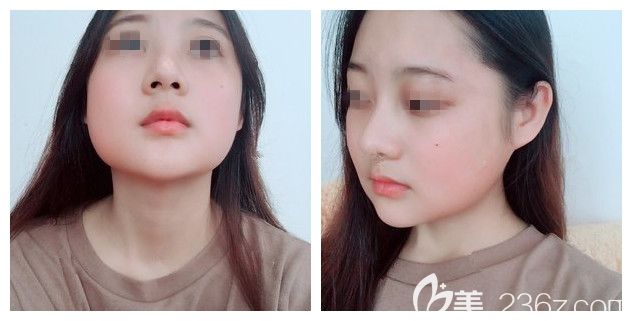 面診<!--<i data=20240703-sp></i>-->術(shù)前面部肥胖 面診<!--<i data=20240703-sp></i>-->術(shù)前面部肥胖