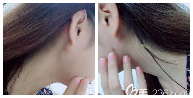 術(shù)后十天面部吸脂的恢復情況 術(shù)后十天面部吸脂的恢復情況