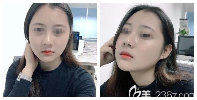 一個月后面部吸脂的輪廓已經(jīng)基本顯現(xiàn) 一個月后面部吸脂的輪廓已經(jīng)基本顯現(xiàn)