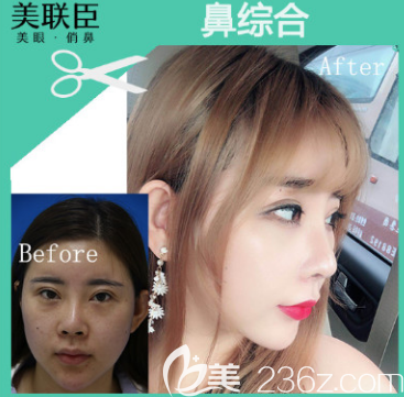 淄博美聯(lián)臣隆鼻案例