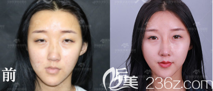 <!--<i data=20240703-sp></li>
?
<li><i data=20240703-sp></i>-->隆鼻案例