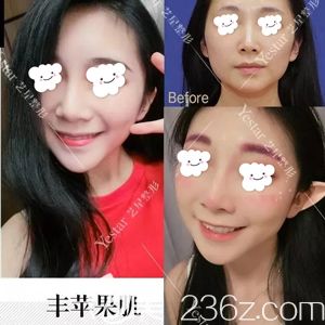 武漢藝星做自體脂肪填充蘋果肌術(shù)后恢復效果