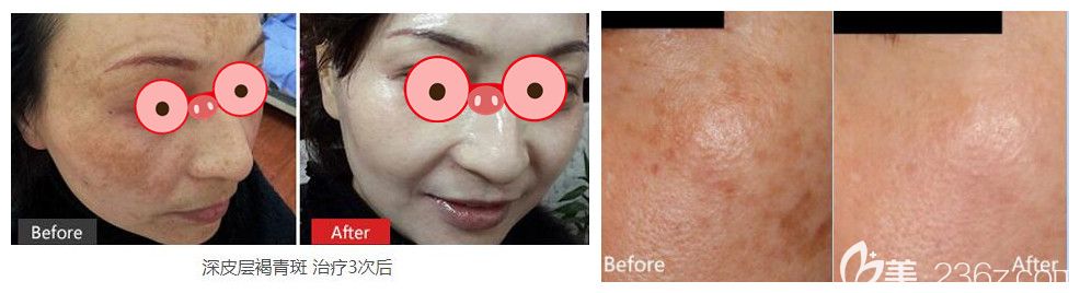 淮北哪里祛斑好？時(shí)光整形激光祛斑案例來驗(yàn)證