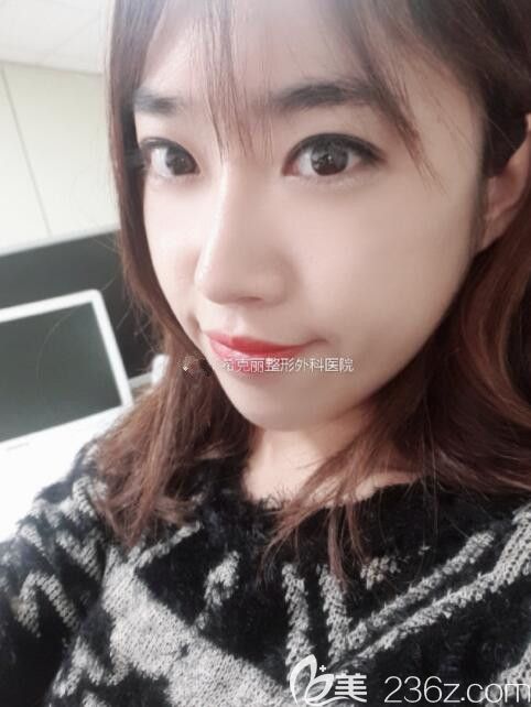 腫泡眼在韓國希克麗趙鏞瑾做了雙眼皮眼底脂肪排列很滿意不后悔